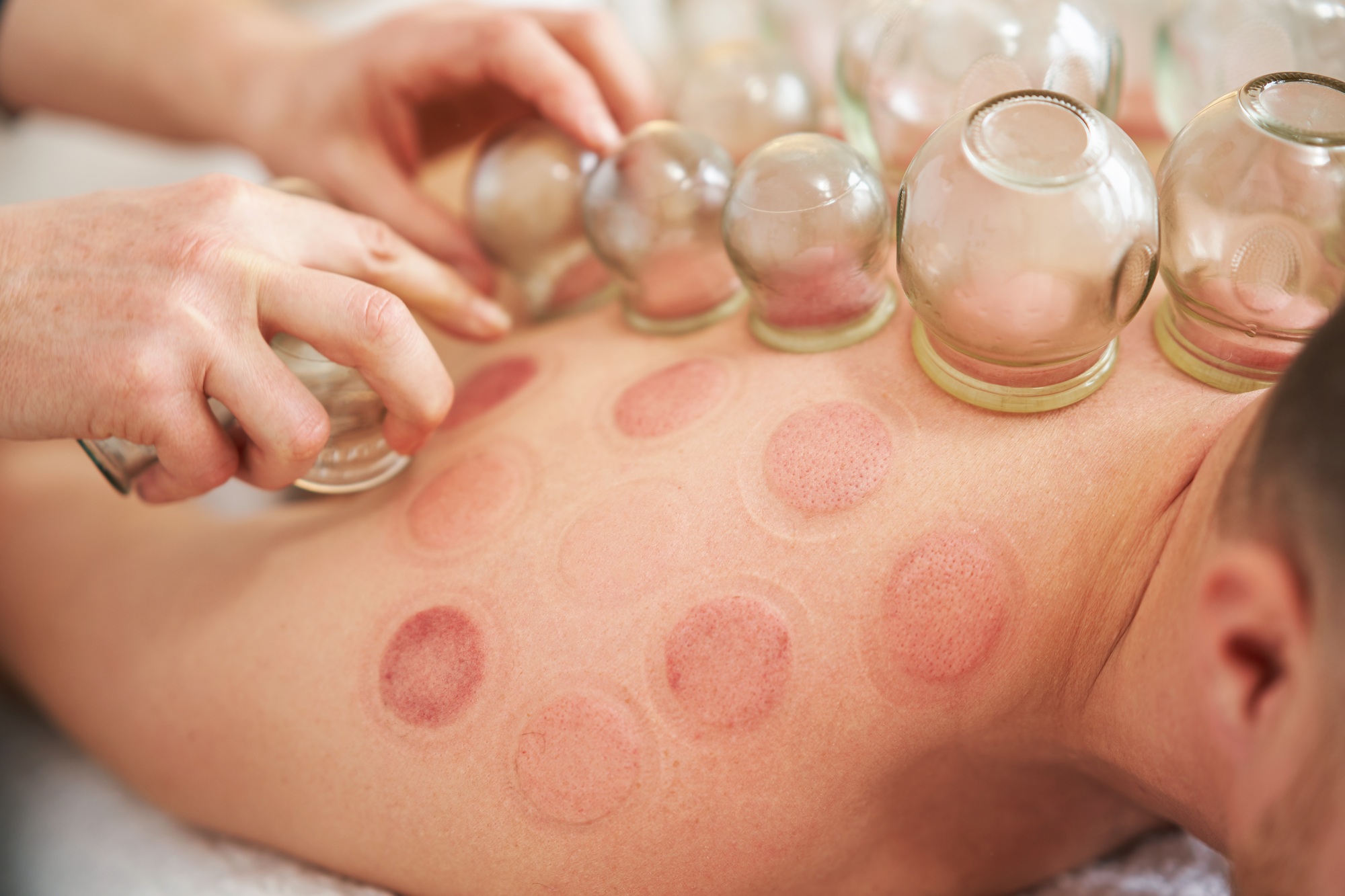 A picture of a man having cupping therapy