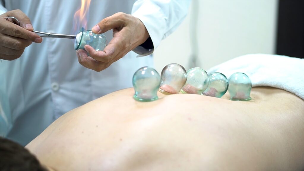 Acupuncture therapist placing a cup on the back of a male patient, ancient Chinese alternative
