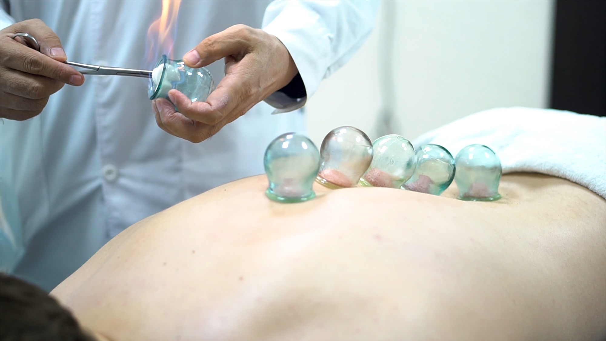 Acupuncture therapist placing a cup on the back of a male patient, ancient Chinese alternative